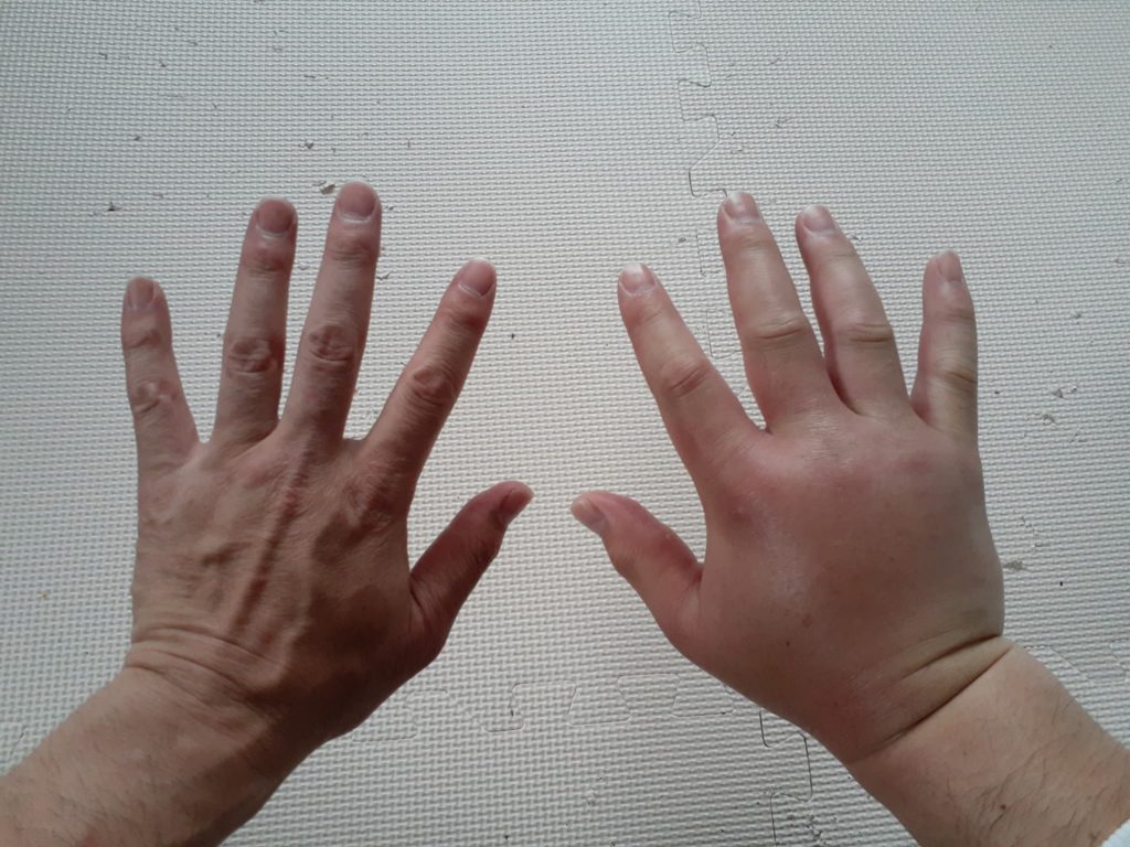 以前スズメバチに刺された時の手の違い